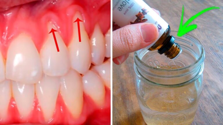 3 Solutions Naturelles Pour Traiter Les Gencives Qui Se Rétractent