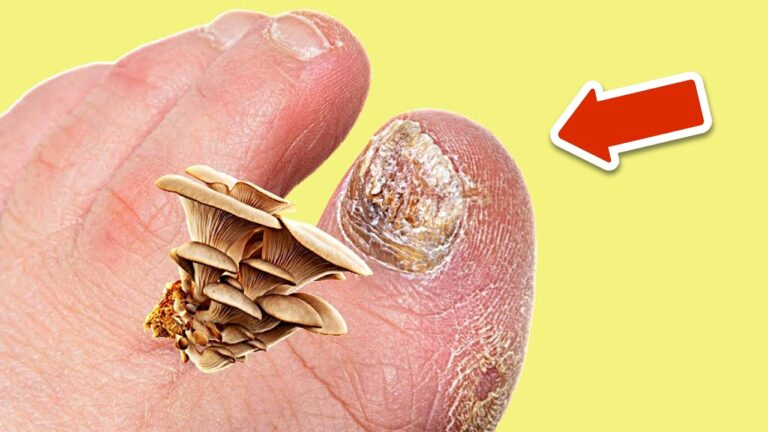 Éliminez les infections fongiques en 3 étapes avec ce remède naturel !
